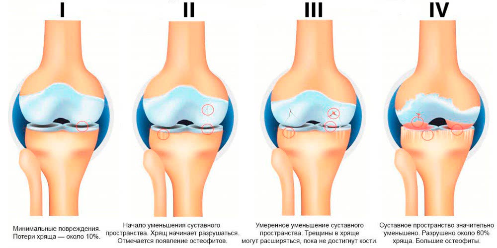 Степени артроза